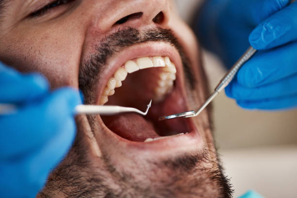 Best Emergency Wisdom Teeth Removal in Winchester, KY