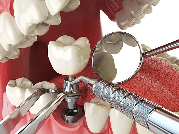 Best Emergency Treatment for Toothache in Winchester, KY